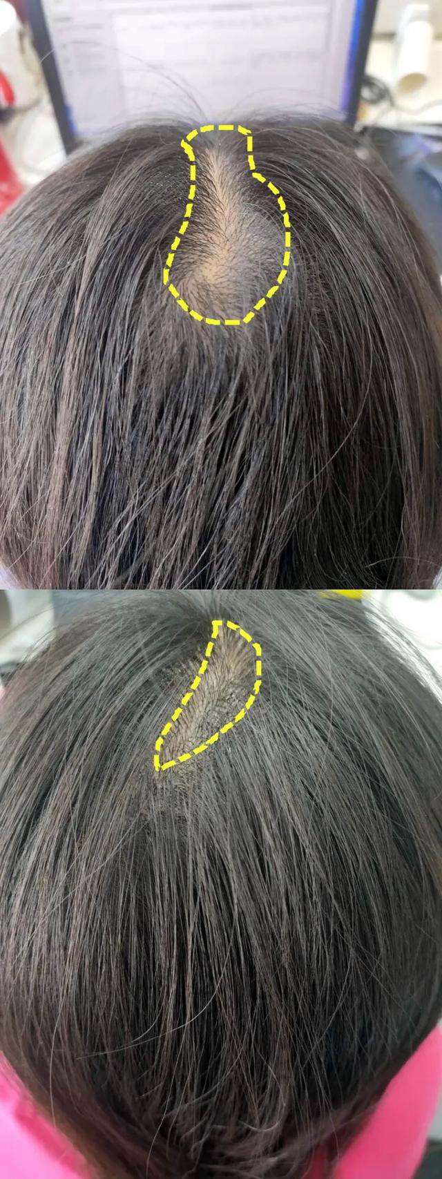 若何增加头发密度，让头发又黑又多又密？