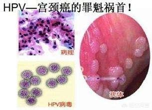 查抄HPV是阳性16，但此外查抄没问题，需要治疗吗？需要留意什么？