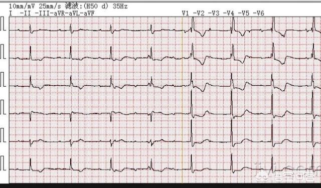 如何去做心电图查抄才尺度？