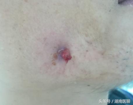 为什么牙医都喜好拔智齿strong邓旋/strong？