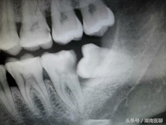 为什么牙医都喜好拔智齿strong邓旋/strong？