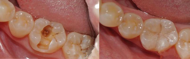 牙齿烂了strong邓旋/strong，补牙仍是拔牙？