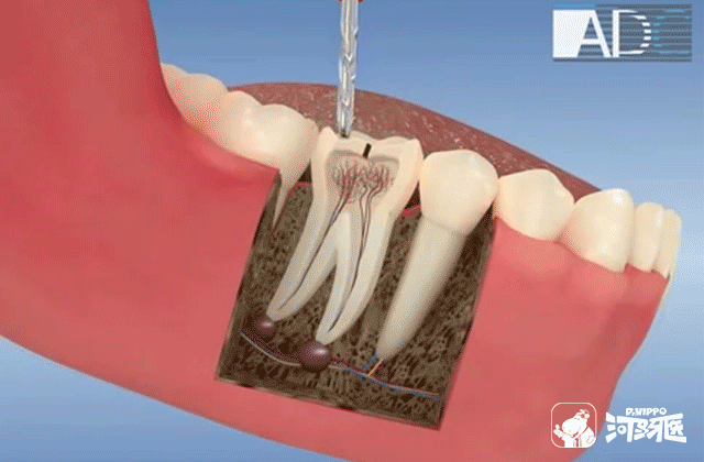 牙齿烂了strong邓旋/strong，补牙仍是拔牙？
