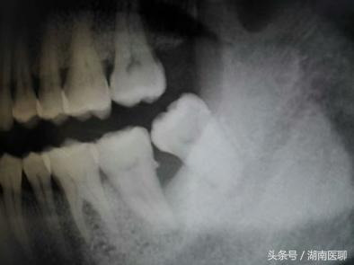 为什么牙医都喜好拔智齿strong邓旋/strong？