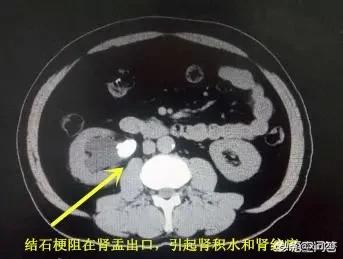 1厘米肾结石要碎石吗<strong></p>
<p>李高启</strong>？