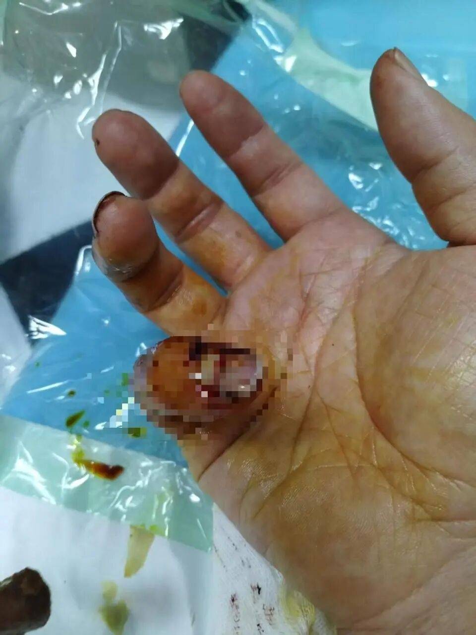 理发店主阻拦城管撕广告被咬伤手指,警方:城管误认为商户阻拦行为是殴打,将调查处置