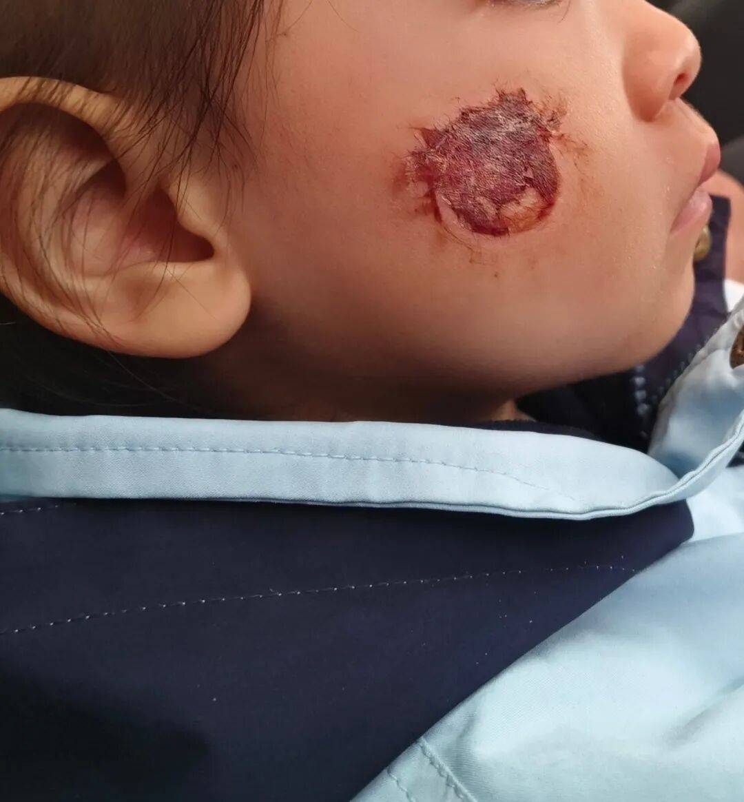 3岁女童脸部糜烂，这东西很多人都在玩！紧急提醒