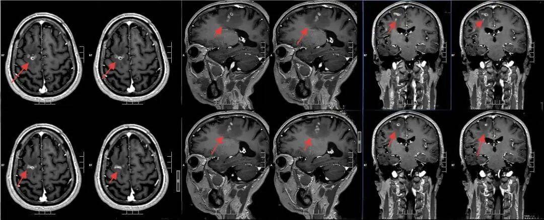 广东一男子20多年不敢一个人出门，医生从他脑中取出10厘米活虫