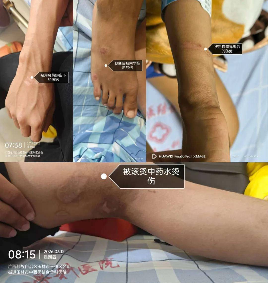 “被警棍追打，夜里绑在铁架床上”，14岁少年特训学校矫治网瘾，遭虐待双腿骨折学校隐瞒，医生发现异常果断报警