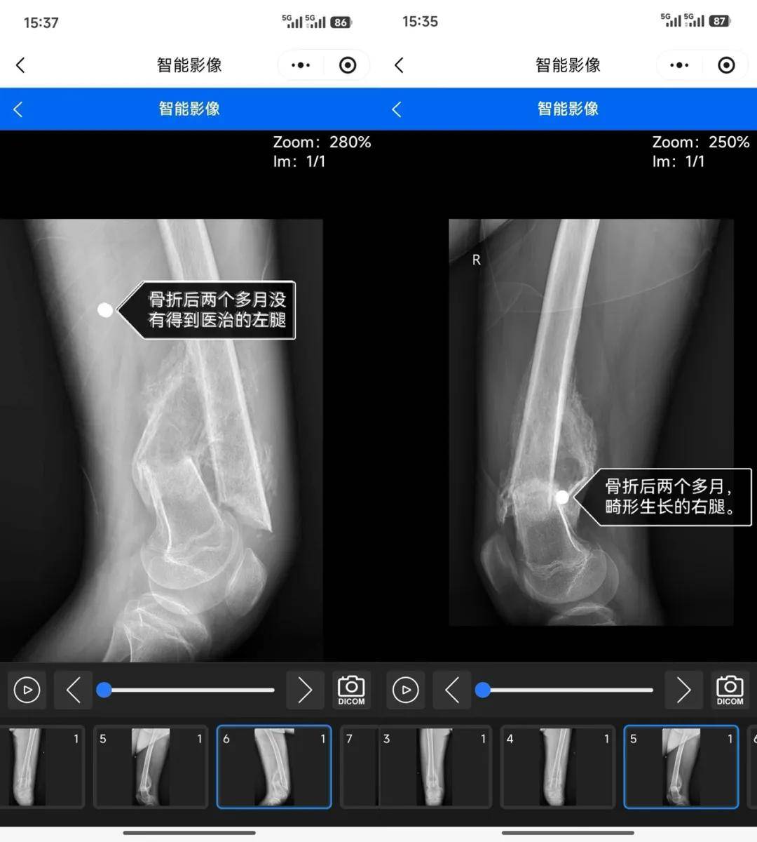 “被警棍追打，夜里绑在铁架床上”，14岁少年特训学校矫治网瘾，遭虐待双腿骨折学校隐瞒，医生发现异常果断报警